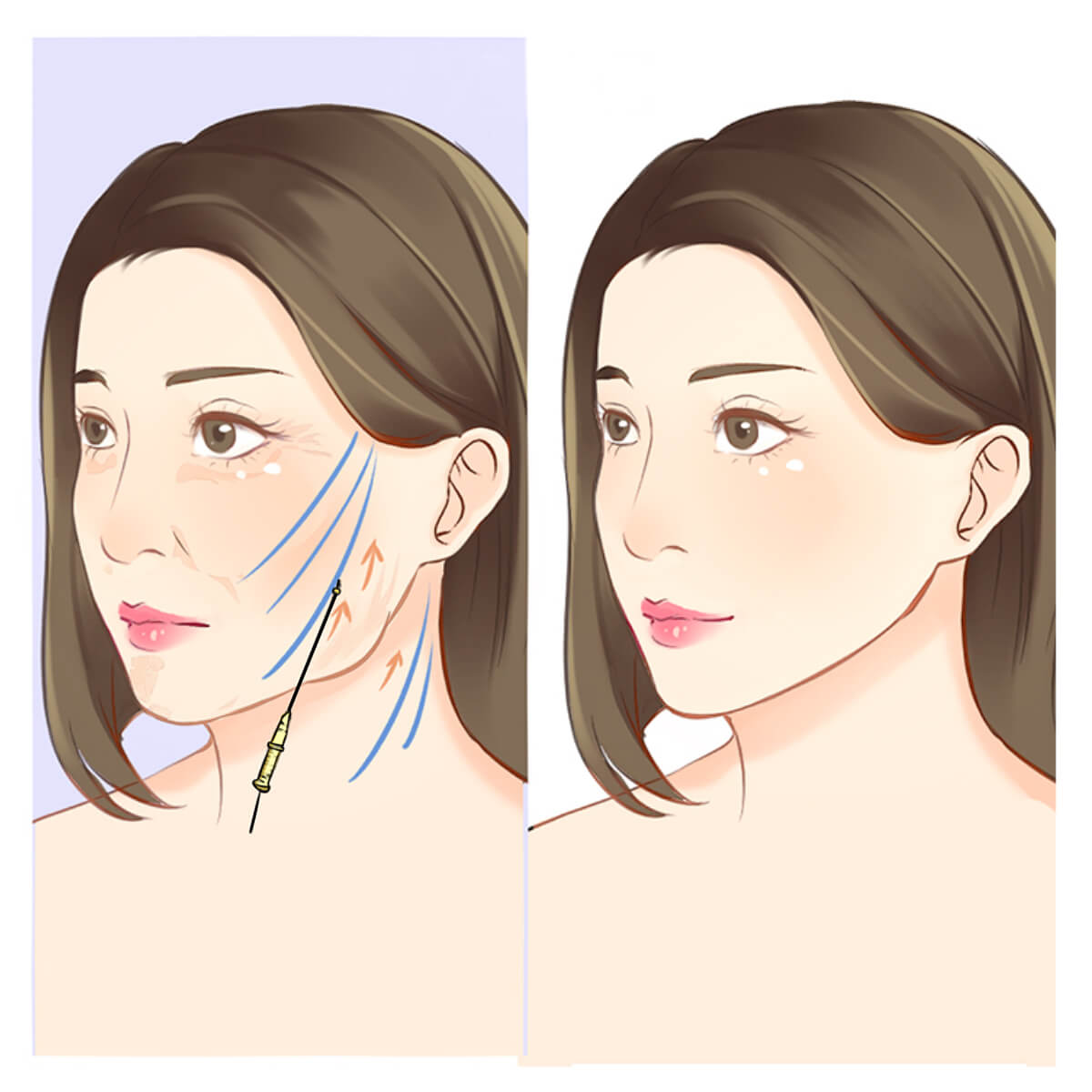 Can I Get a V-Shape Face Without Surgery? Answered by Beverly Wilshire  Medical Centre