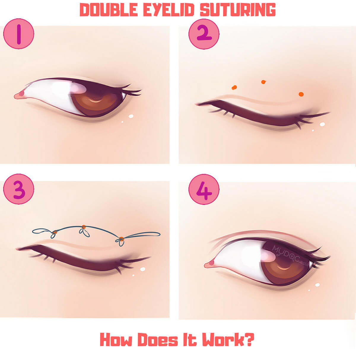 double eyelid training