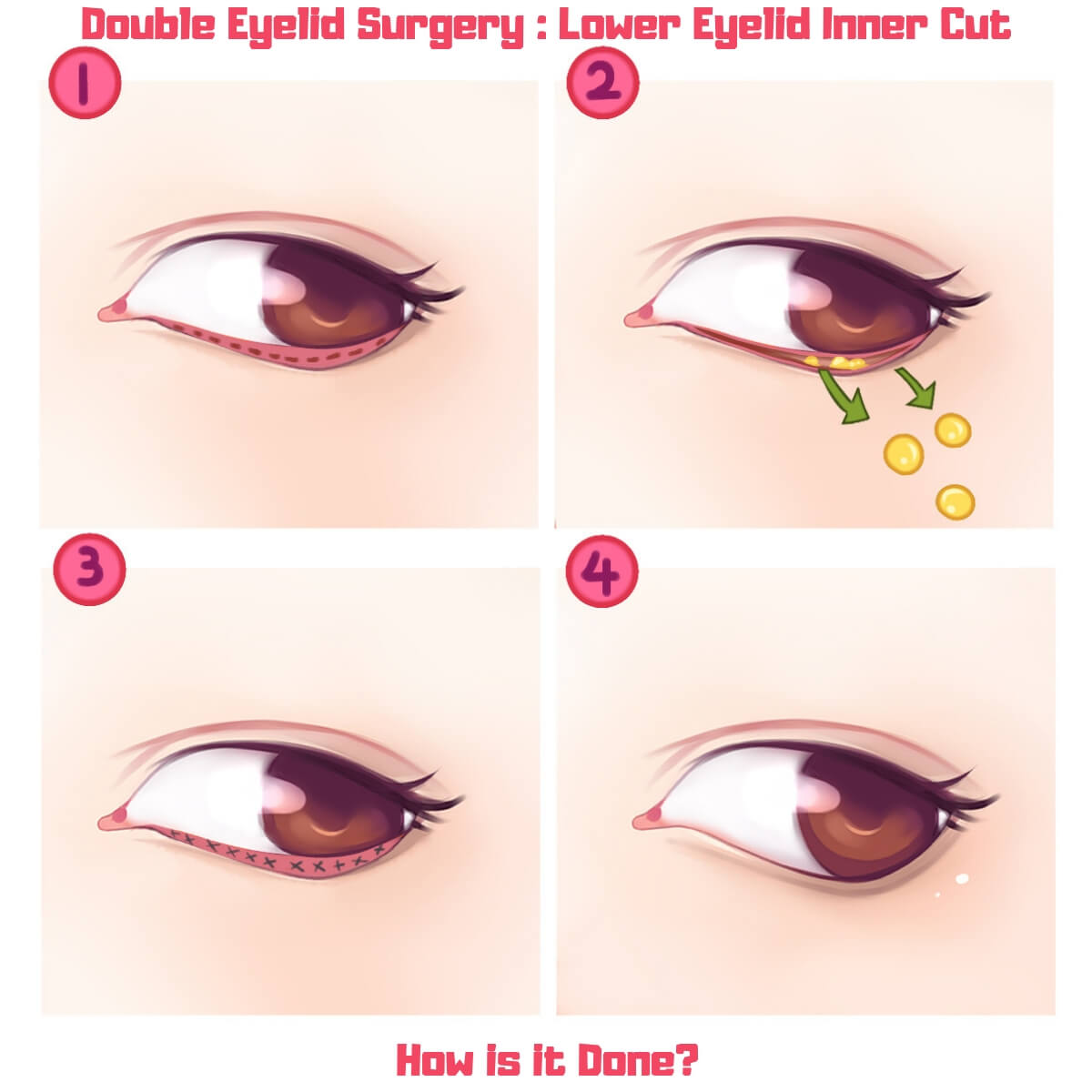 Lower Eyelid Surgery Inner En Mydoctiny 