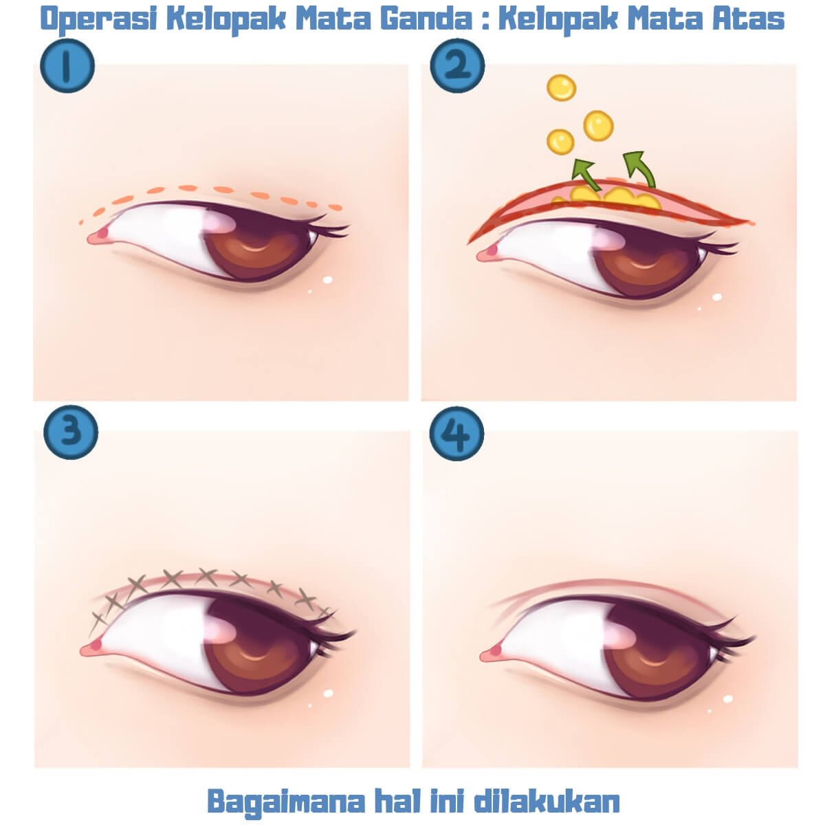 Bagaimana Cara Mendapatkan Kelopak Mata Ganda Secara Permanen Jawaban Oleh Beverly Wilshire Medical Center Erufu Care