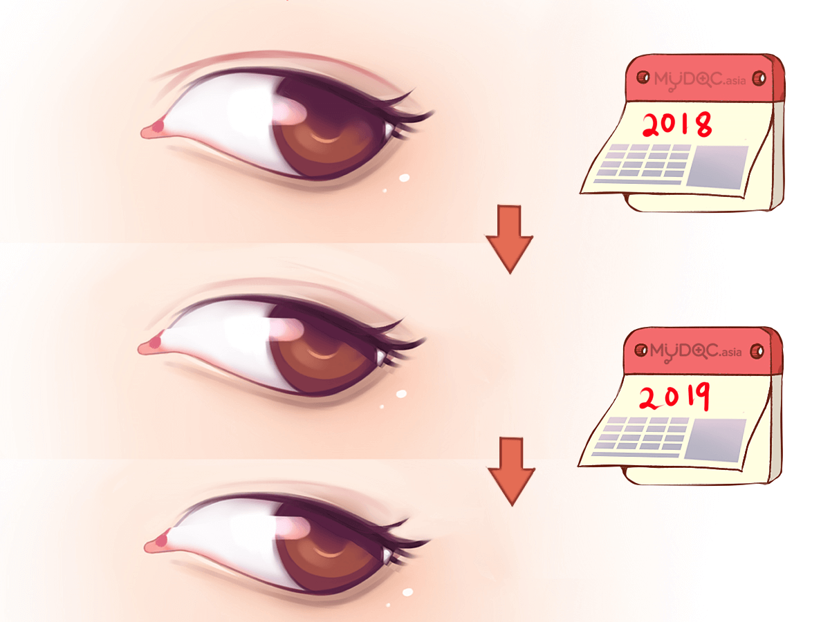 Permanent 2025 double eyelid