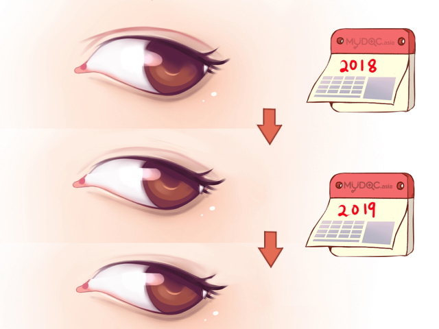 double eyelid suture