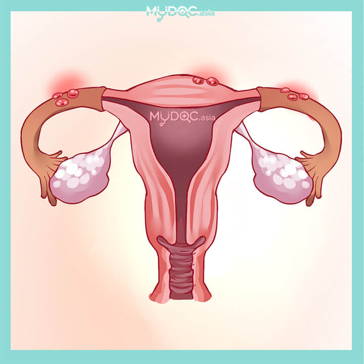 13 Best Endometriosis Treatment In Malaysia Price Guide Reviews