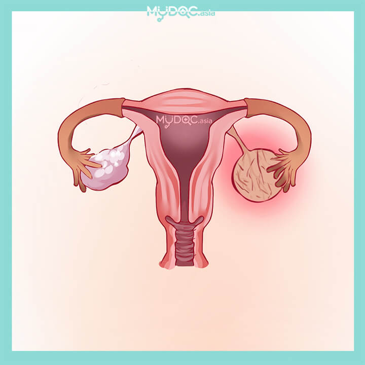 12 Best Ovarian Cyst Treatment In Malaysia Price Guide Reviews